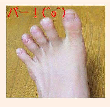 気づかないうちに子どもの足に様々な症状が隠れていたら 浮き指 編