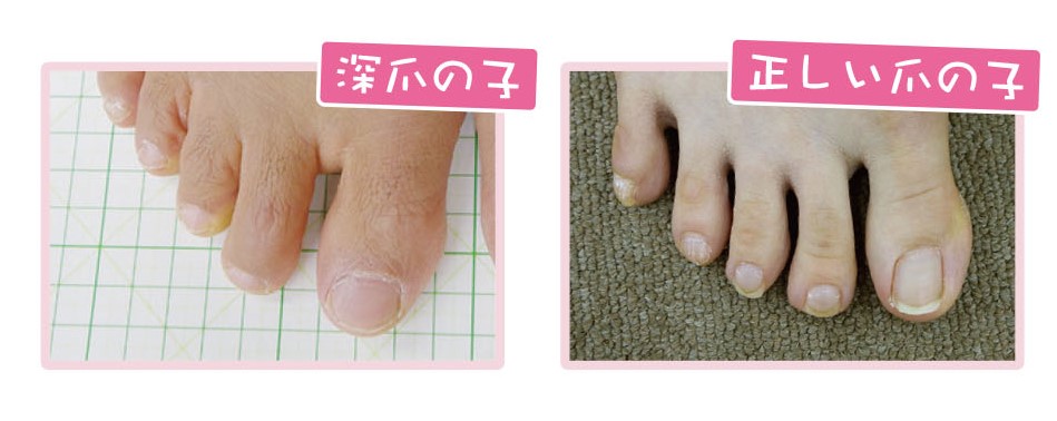 気づかないうちに子どもの足に様々な症状が隠れていたら 浮き指 編